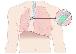See full list on hopkinsmedicine.org Atelectasis Amboss