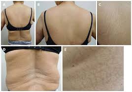 Image result for Diffuse Hyperpigmentation