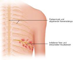 Charakteristisch sind rötungen und bläschen auf. Gurtelrose Gesundheitsinformation De