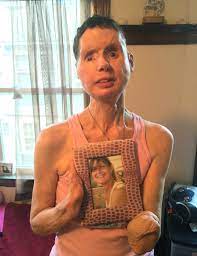 Charla Nash opens up about recent face transplant setback, living  independently