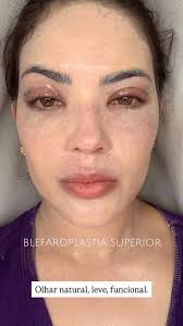 Um olhar mais leve, natural e confortável transforma muito mais do que a  aparência. Devolve segurança, qualidade de vida e aquela autoestima que faz  falta no dia a dia. Ver essa evolução e saber que ...