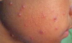 Persoane pe an au varsat de vint. Varicela Varsatul De Vant La Copii Simptome Si Tratament