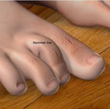 Hammertoe This Condition Is A Deformity In Which A Toe Bends Downward At The Middle Joint The Second Toe Is The One Hammer Toe Surgery Hammer Toe Middle Toe