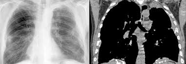 /æsˈbɛstəs/ or /æsˈbɛstɒs/) is a term used to refer to six naturally occurring silicate minerals. Asbestose Verstarktes Bewusstsein Und Erweitertes Vorsorgeangebot Sollen Mortalitat Senken Medical Tribune