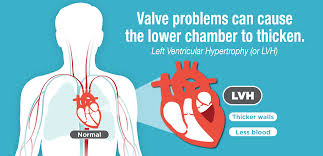 What Is Left Ventricular Hypertrophy Lvh American Heart Association
