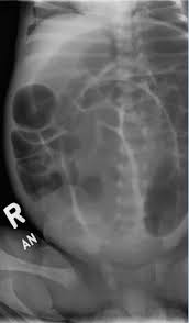 Hirschsprung Disease Consultant360