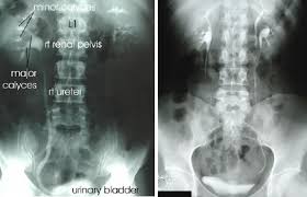 Image result for Intravenous Pyelogram