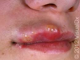 Image result for oral herpes symptoms roof of the mouth