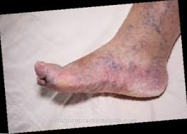 We did not find results for: Air Di Kaki Sebab Rawatan Pertolongan Gejala