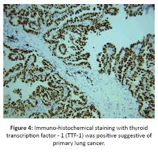 Non Resolving Lung Infiltrate A Rare Case Of Papillary Adenocarcinoma Of The Lung Insight Medical Publishing