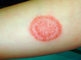 سعفة عند الأطفال كيفية علاج المرض بسرعة