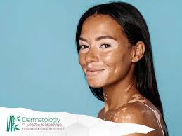 Image result for Vitiligo