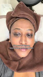 Microneedling with Rejuran Before and After Brown Skin