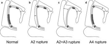 Hurt my flexor palmaris profoundus tendon on both sides and have had pain for 3 weeks in my forearm. Imaging Of Rock Climbing Injuries Radiology Key