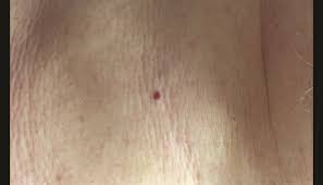 Most of the time, a cherry angioma appears on an elderly patient, or slowly after an individual turns age thirty. Small Vascular Red And Violet Lesions Clinical Advisor