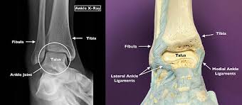 Image result for Ankle Dislocation