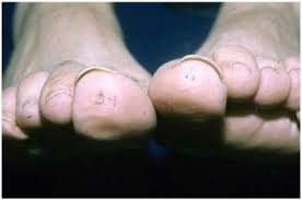 Image result for Onychotillomania feet