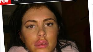 Девушка едва не ослепла после того, как у нее лопнули накаченные губы —  18.02.2020 — В мире, Lifestyle на РЕН ТВ