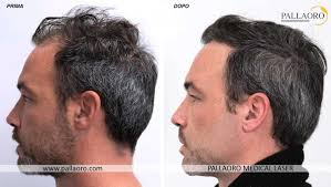 I prezzi dei trapianti di capelli partono dai 3.000 € e, in italia, possono arrivare fino a 9.000 €. Trapianto Capelli Foto Chirurgia Estetica Capelli Prima Dopo