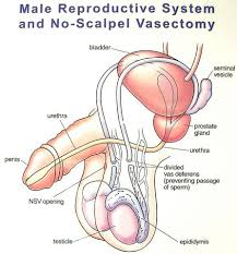 Image result for Vasectomy