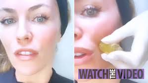 Abbey Clancy has her face injected with 20 gold-coated needles during £500  'baby Botox facial' to keep her looking young