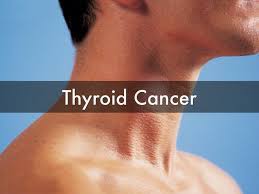 Hoarseness trouble swallowing breathing problems pain in the throat or neck. Thyroid Cancer Types Signs Symptoms Stages Treatment