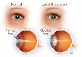 Cataracts can occur at any age, but they are most commonly the result of aging. Babies Can Have Cataracts Too Ensure Regular Eye Check Up From Birth Itself Apn News
