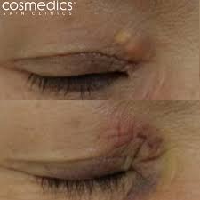 Image result for xanthelasma of eyelid