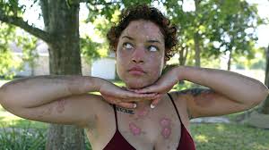 List Of Autoimmune Diseases With Symptoms And Treatments