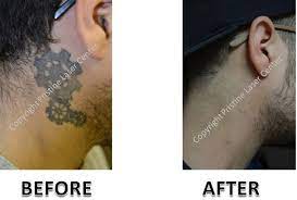 Airmen can have tattoos on their arms, chest, back, and legs without size stipulations. Before And After Laser Tattoo Removal Orlando Pristine Laser Center Pristine Laser Center Orlando