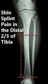 Image result for Shin Splints