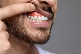 Image result for gingivitis