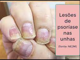 É bem comum e atinge mais da metade das pessoas diagnosticadas com a doença. Psoriase E Reumatismo Youtube