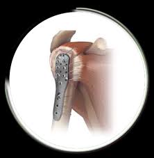 Omuz Kiriklari Op Dr Taner Bekmezci