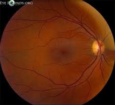 Image result for HIV Retinitis