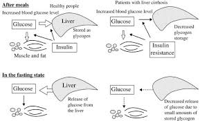 Cirrhosis is scarring of the liver. Liver Cirrhosis And Metabolism Sugar Protein Fat And Trace Elements Sciencedirect