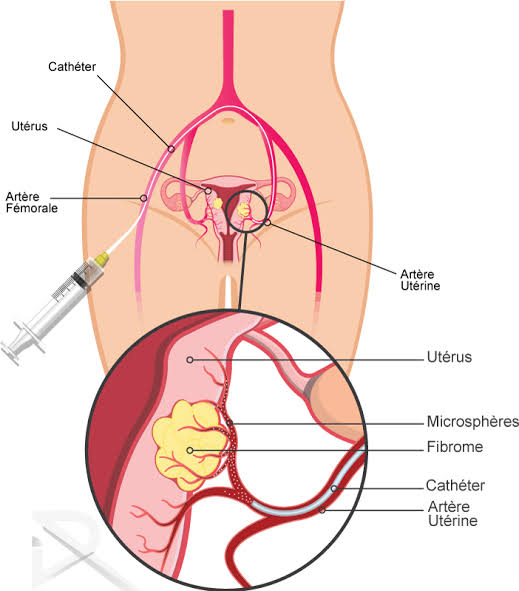 Fibrome traitement naturel