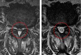 Lumbale Spinalkanalstenose Ursachen Diagnose Therapien Orthinform