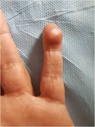 Treatments for common skin problems. Rare Tumor In Unusual Location Glomus Tumor Of The Finger Pulp Clinical And Dermoscopic Features A Case Report Journal Of Medical Case Reports Full Text