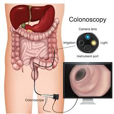 Image result for Colon Cancer Screening with Colonoscopy