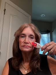 What is microneedling skin treatment?