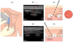 Image result for Intrapleural Anesthesia