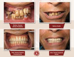 Apparently, the costs would really go down with the help of an insurance. Dental Implants In Dubai Uae Implantologist In Dubai
