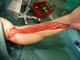 Escharotomy is a way of treating third degree circumferential burns that are mostly found on the chest and the limbs. Escharotomy Vs Fasciotomy What S The Difference Ask Difference