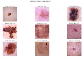 The skin is made up of three layers, including the epidermis, which is the top layer of the skin. Deep Learning For Diagnosis Of Skin Images With Fastai By Aldo Von Wangenheim Towards Data Science