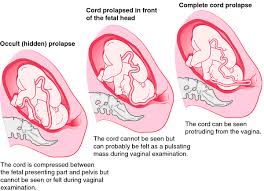 Prolapse Of The Cord Ob Nursing Medical Dictionary Nursing School Tips