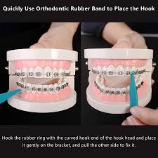 The angle of the brace will vary depending on the curve on this side of. Buy Lovewee Dental Elastic Rubber Bands Placers For Braces 20 Pcs Disposable Plastic Orthodontic Elastic Placers Multi Color Online In Indonesia B08sl2f64w