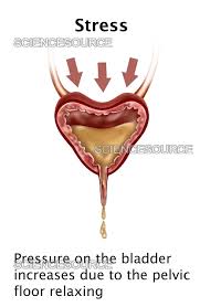 Image result for Stress Incontinence