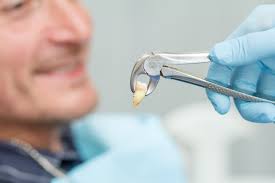 Root Canal vs Extraction: Which One to Pick?