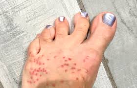 Image result for Chigger